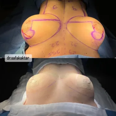Breast lift