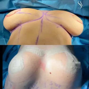 Breast lift