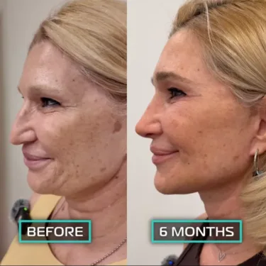Facelift