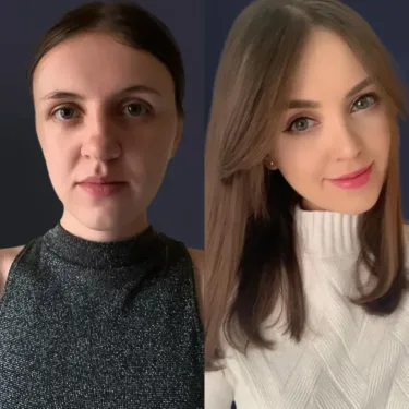 Facelift
