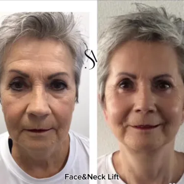 Facelift