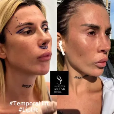 Facelift