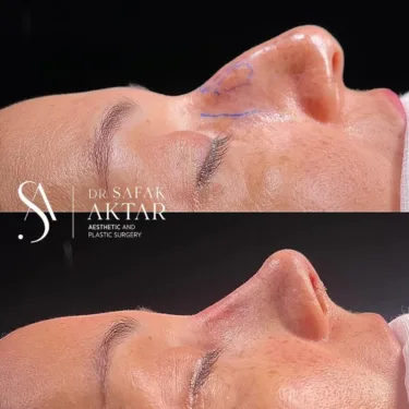 Rhinoplasty