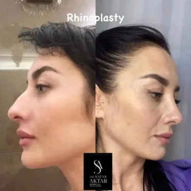 Rhinoplasty