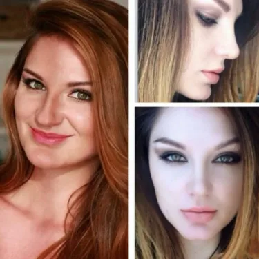 Rhinoplasty