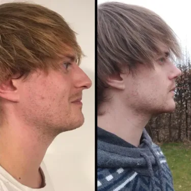 Rhinoplasty