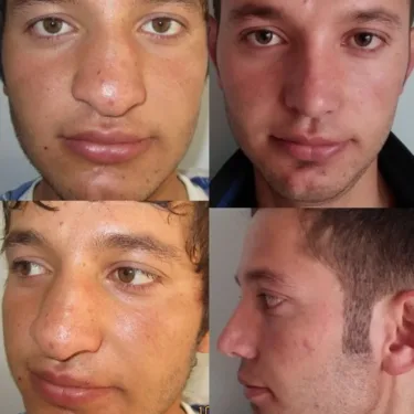 Rhinoplasty