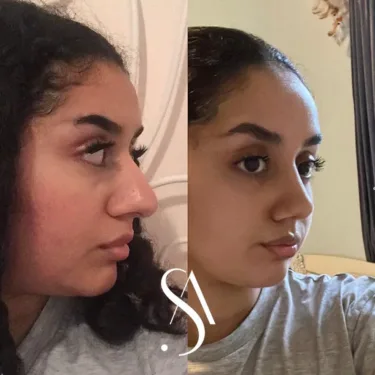 Rhinoplasty