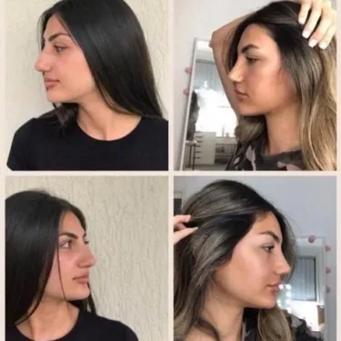 Rhinoplasty