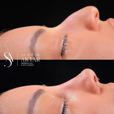 Rhinoplasty