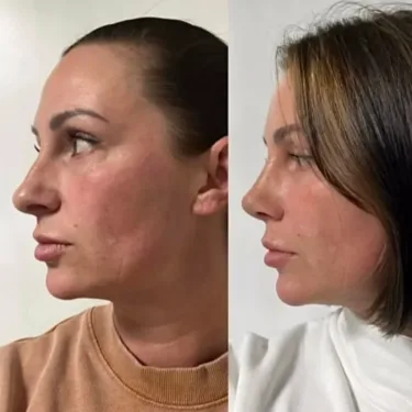 Rhinoplasty