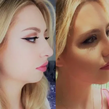 Rhinoplasty