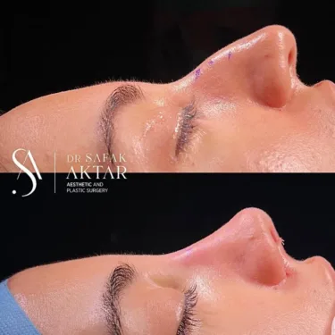 Rhinoplasty