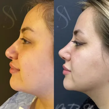 Rhinoplasty