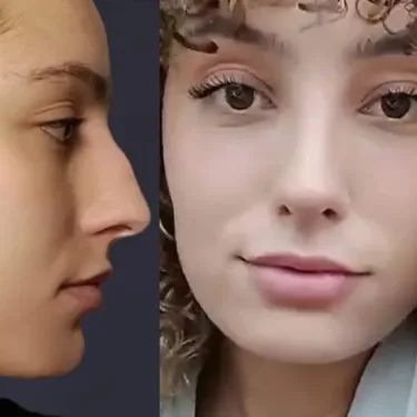 Rhinoplasty