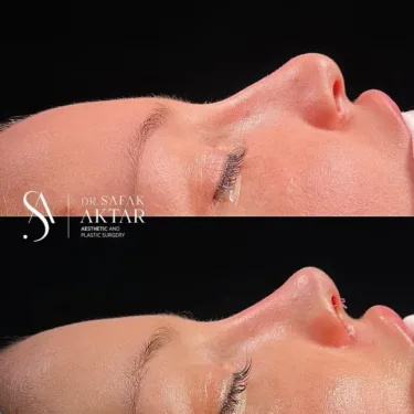 Rhinoplasty