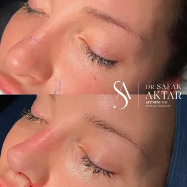 Rhinoplasty