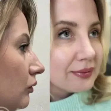 Rhinoplasty