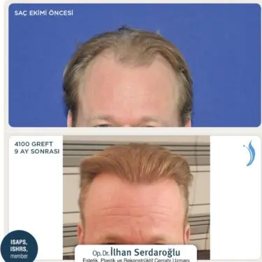 Haartransplantation