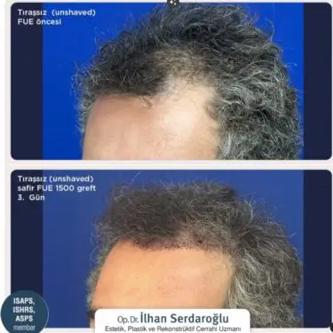 Haartransplantation