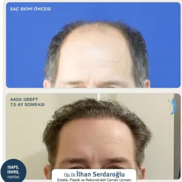 Haartransplantation