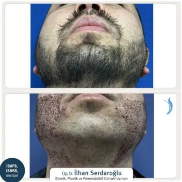 Haartransplantation