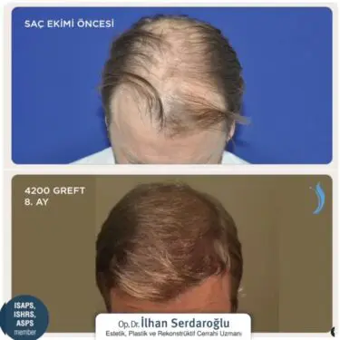 Haartransplantation