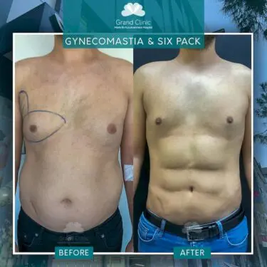 Gynäkomastie, Sixpack