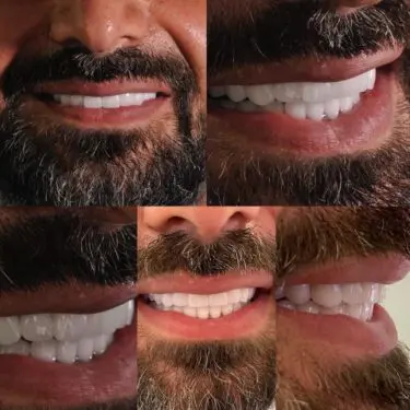 Implantes dentales en Turquía