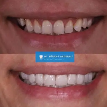 Implantes dentales en Turquía