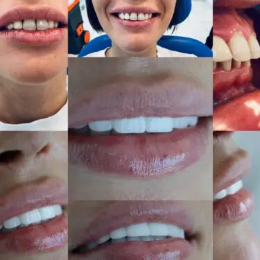 Implantes dentales en Turquía