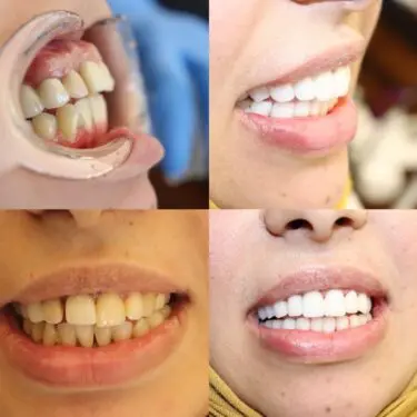Implantes dentales en Turquía