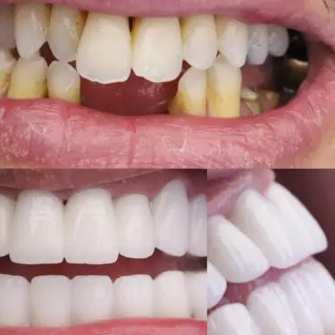 Implantes dentales en Turquía
