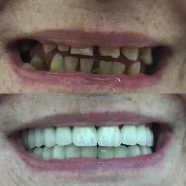 Implantes dentales en Turquía