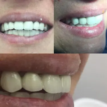 Implantes dentales en Turquía