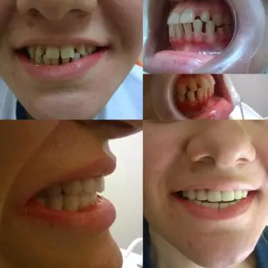 Implantes dentales en Turquía