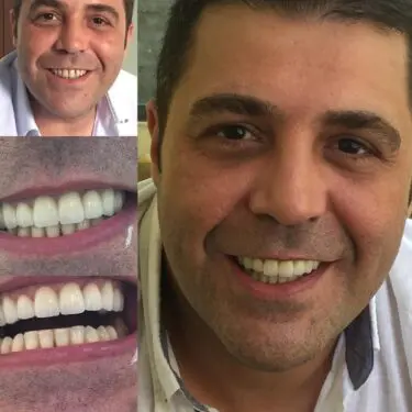 Implantes dentales en Turquía