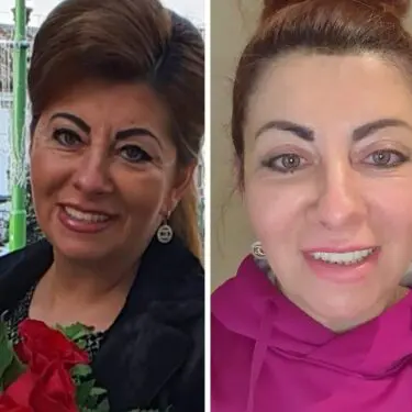 Facelift & neck lifting