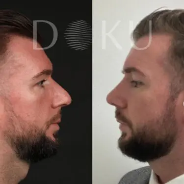 Rhinoplastik