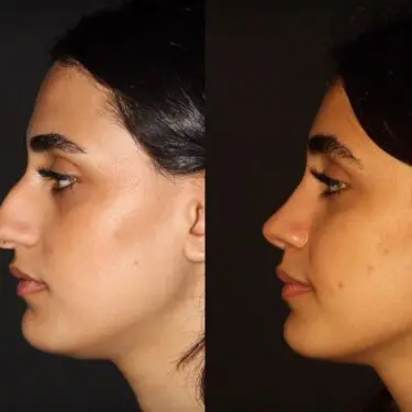 Rhinoplastik