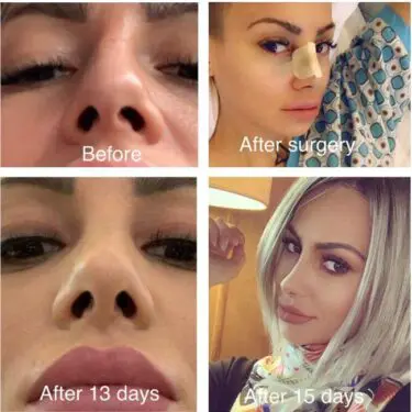 Rhinoplastik