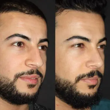 Rhinoplastik