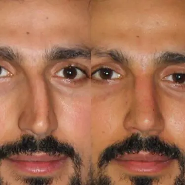 Rhinoplastik