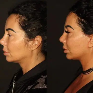 Facelift & neck lifting