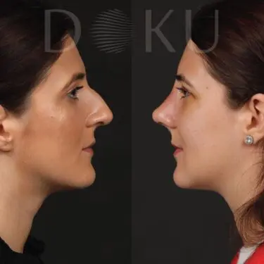 Rhinoplastik
