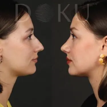 Rhinoplastik