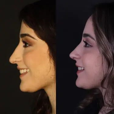 Rhinoplastik