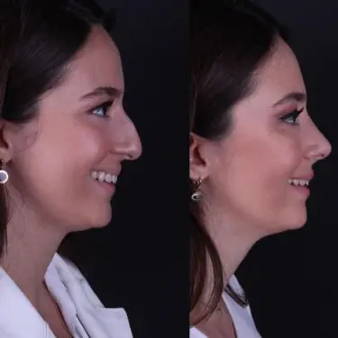 Rhinoplastik