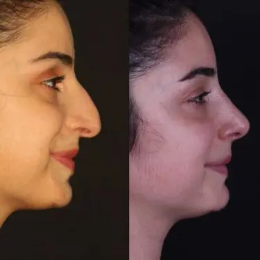 Rhinoplastik