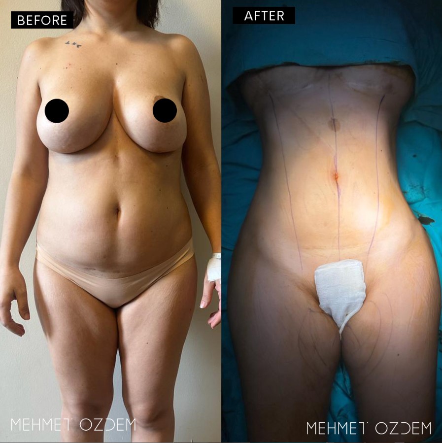 Liposuction + Tummy Tuck